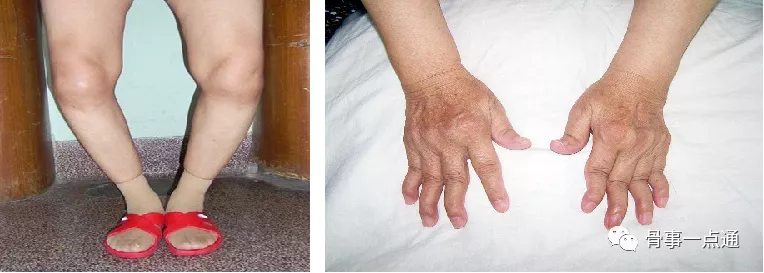 老年退行性骨关节病该如何护理？