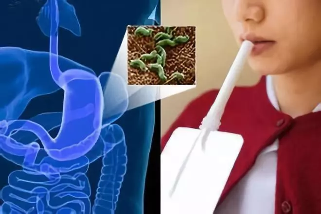 如何用辨识幽门螺杆菌？