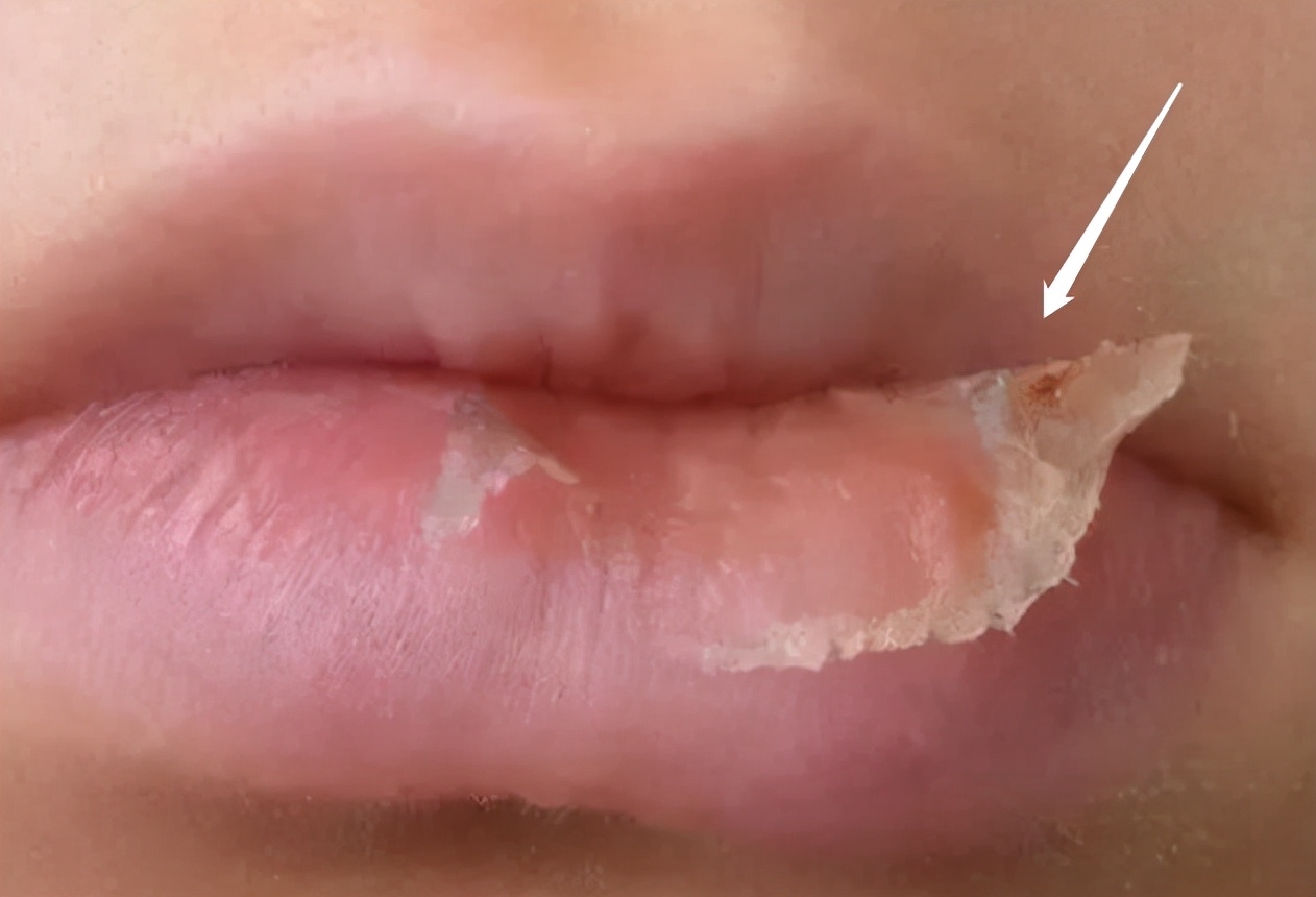 孩子嘴唇裂口干皮又出血，还忍不住撕嘴皮怎么办？