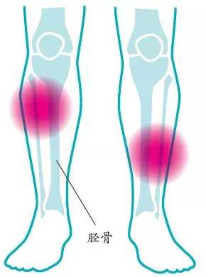 四种常见跑步疼痛的解决方案
