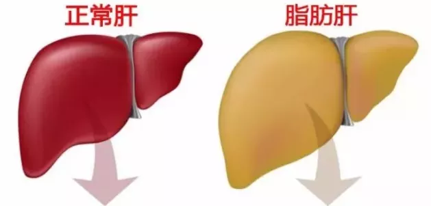 得了脂肪肝，除了减肥，还应做什么？