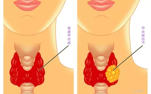 体检查出甲状腺结节怎么办？