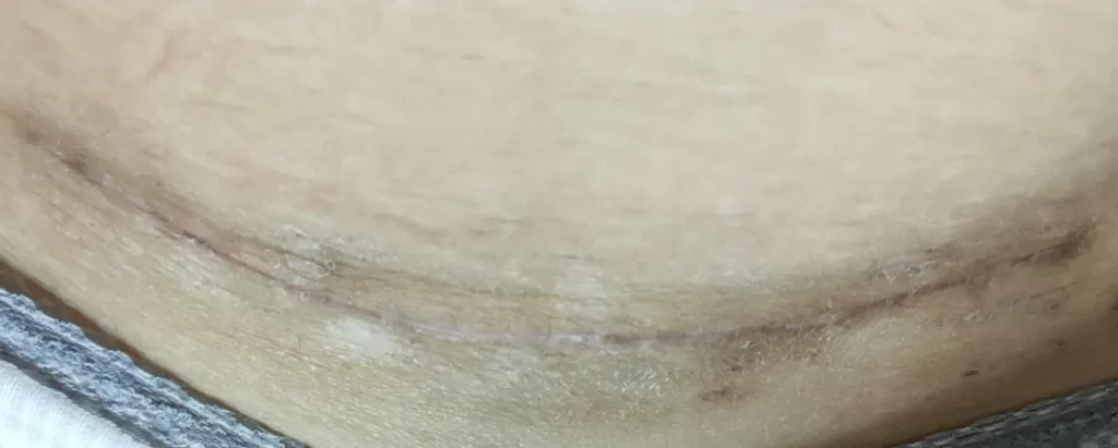 剖腹产后不想皮肤留疤，怎么办？