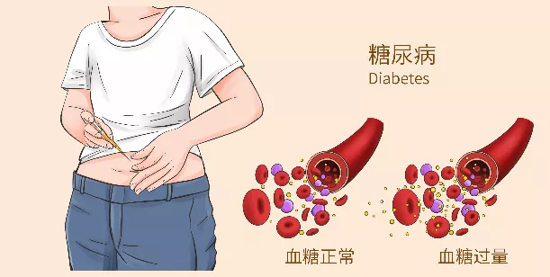 糖尿病在什么时间测血糖好？