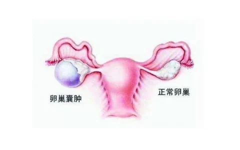 小姑娘为什么会得卵巢囊肿？