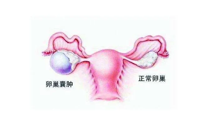 小姑娘为什么会得卵巢囊肿？