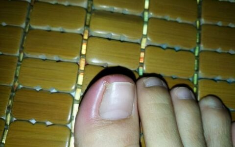 甲沟炎到底有多痛？如何预防甲沟炎？