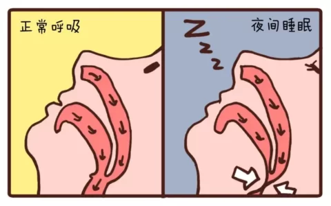 打鼾是睡得香吗？