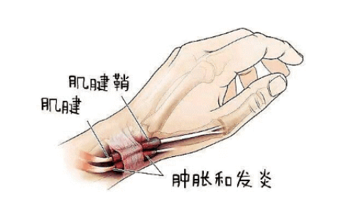 腱鞘炎应该怎么康复治疗？