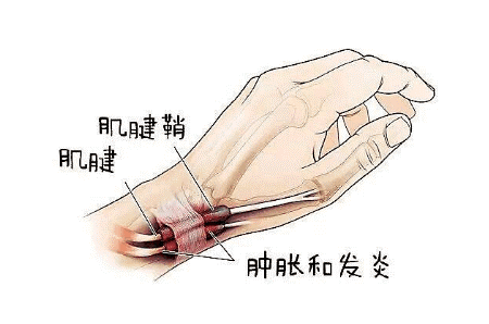 腱鞘炎应该怎么康复治疗？