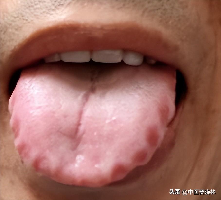 身体有湿、寒、气、食四毒怎么办？