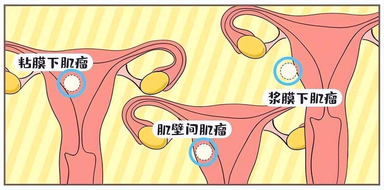 女性为什么容易长子宫肌瘤？
