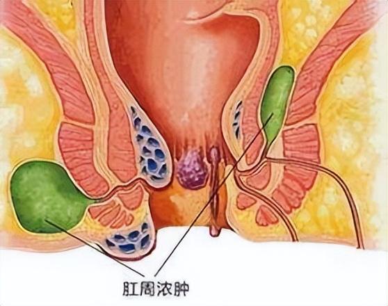 肛门毛太多,是什么原因造成的?能刮掉吗?