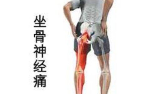 坐骨神经痛有什么表现？怎么运动防止坐骨神经痛？