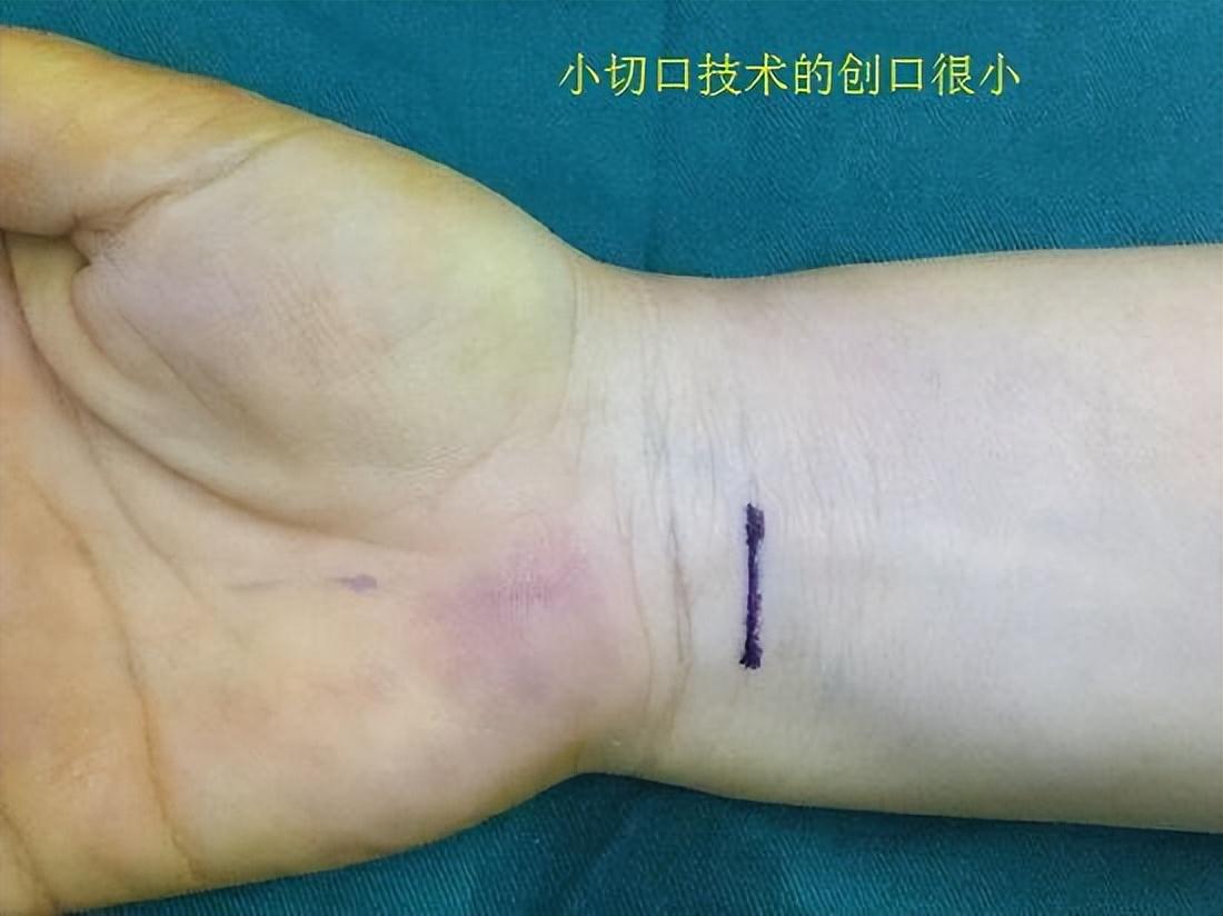 手部麻木、疼痛的几个常见原因及康复训练方法