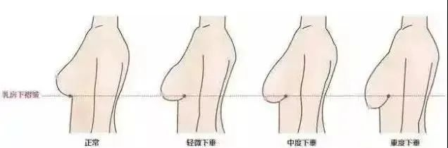 胸部太大的妹子跑步时能有多难受？